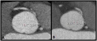 Computed Tomography Derived Coronary Triangulated Orifice Area—Deduction of a New Parameter for Follow-up After Surgical Correction of Anomalous Aortic Origin of Coronary Arteries and Call for Validation